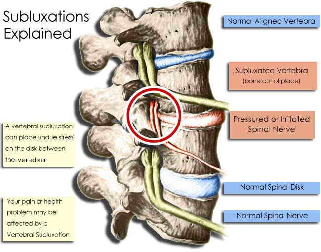 Subluxation image